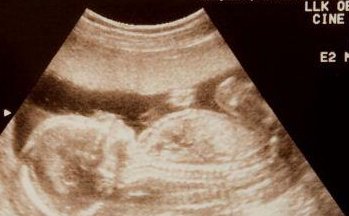 2026年中山三代试管助孕生孩子费用具体是多少？